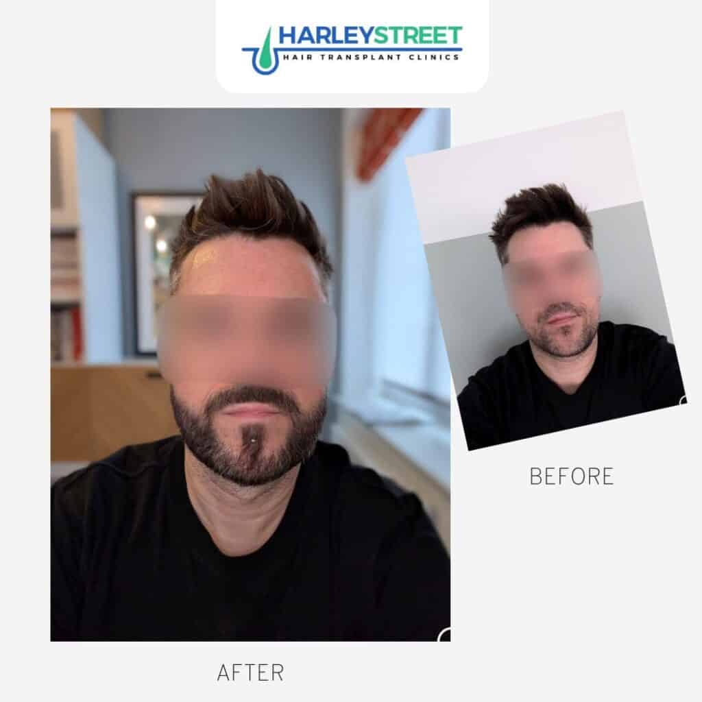 Beard-transplant-before-and-after-Paul-1024x1024