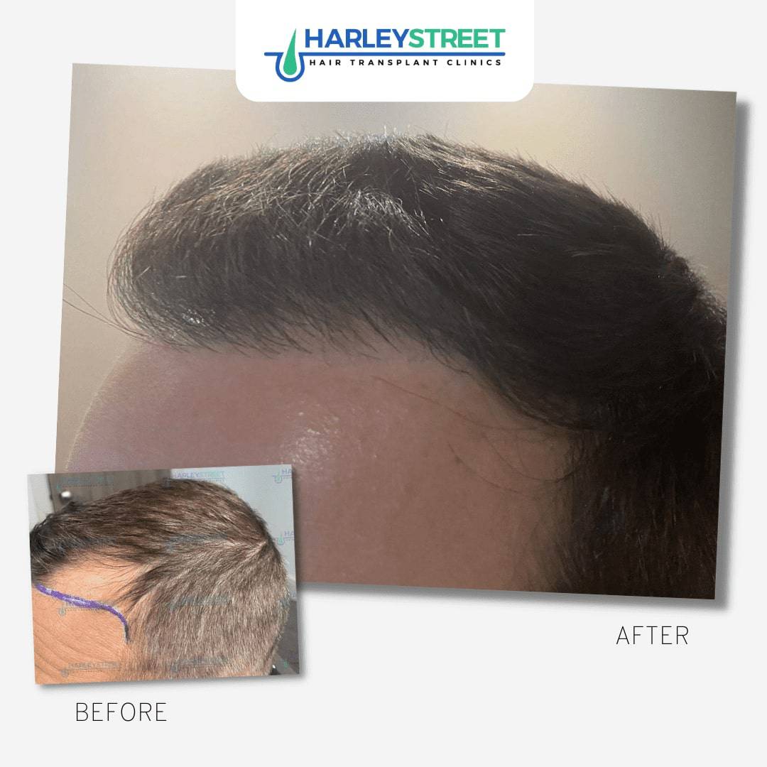 Hair Transplant Leeds Hair Loss Clinic in Leeds