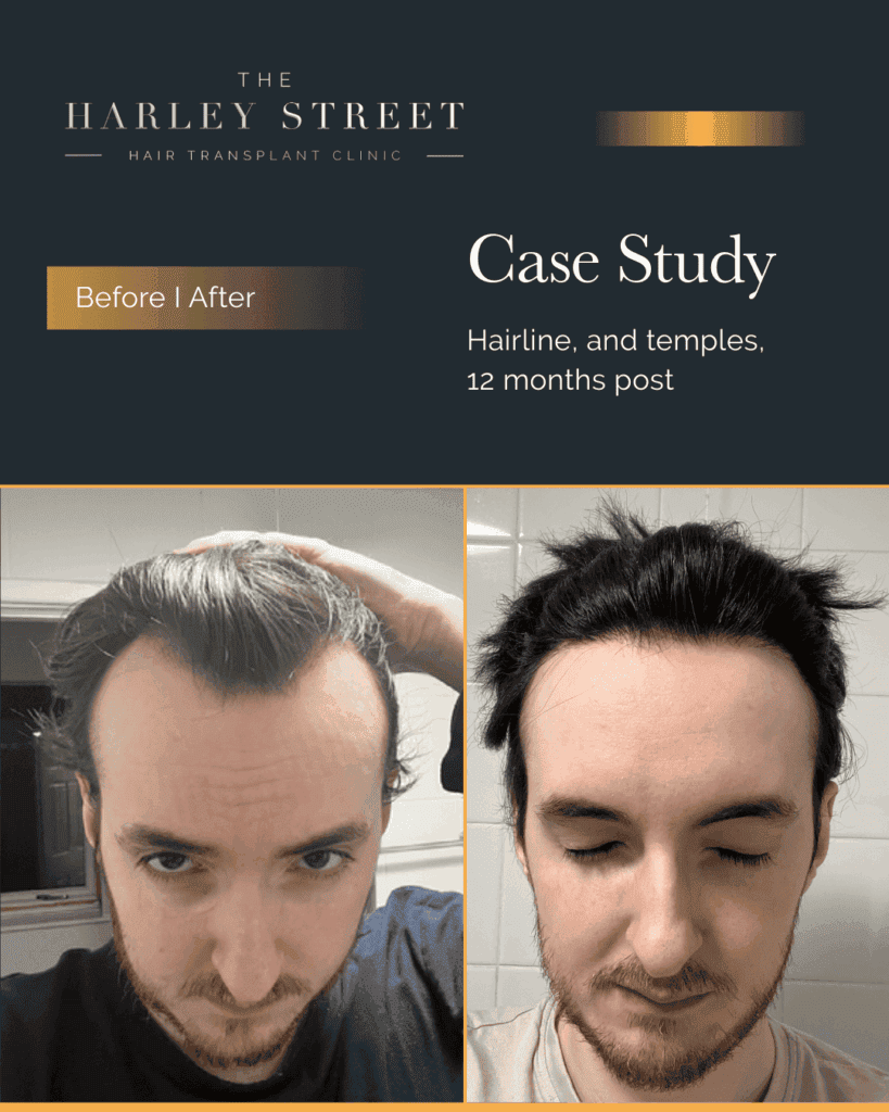Hair-Transplant-Leeds-HT-patient-Elliot-hairline