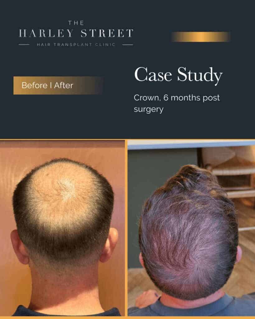 Hair-Transplant-Leeds-HT-pt-AS-crown-largE