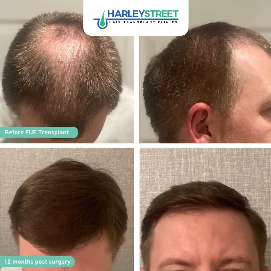 Hair Transplant Leeds Hair Loss Clinic in Leeds
