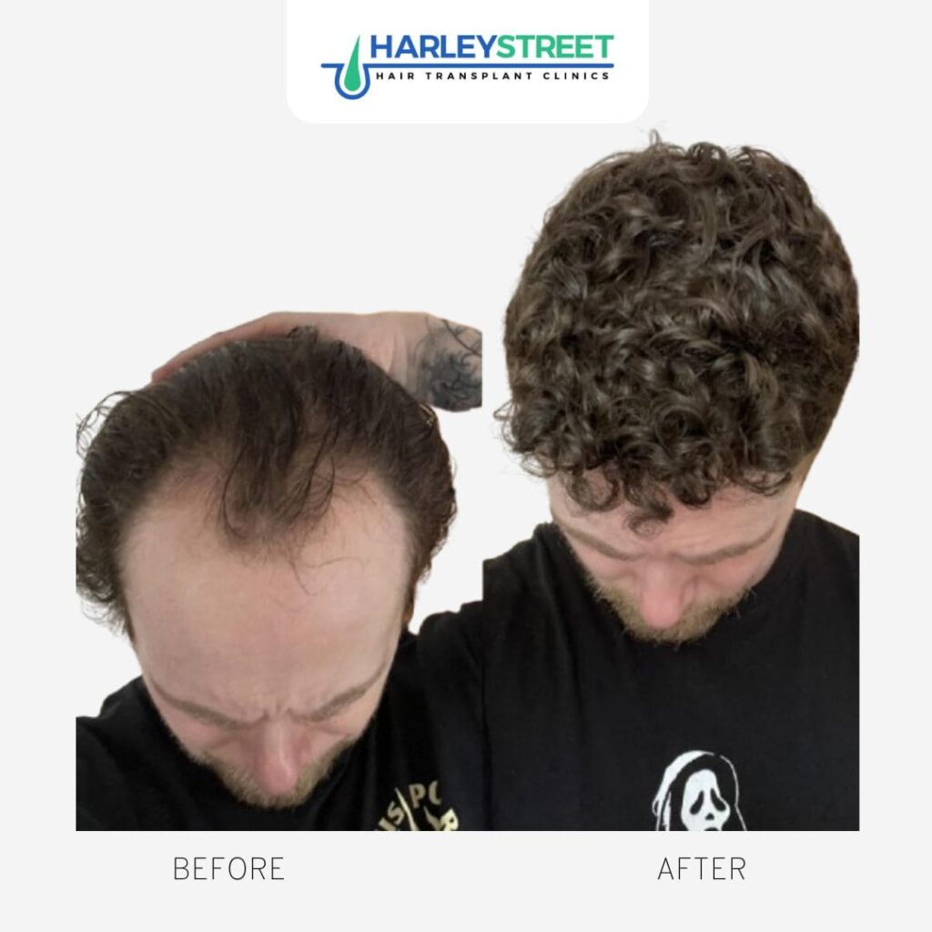 Harley Street HT Pt before and after