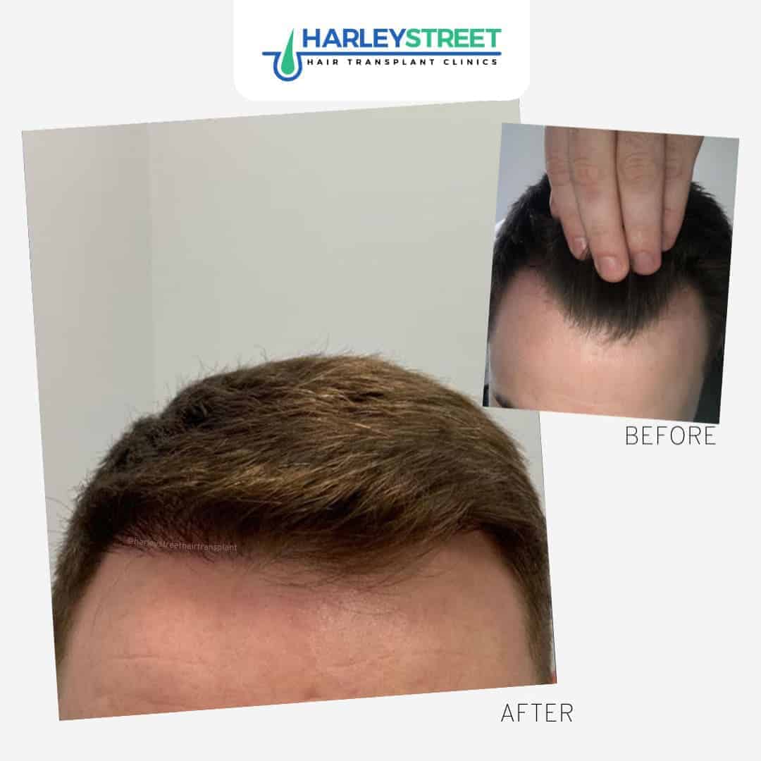 Hair Transplant Leeds Hair Loss Clinic in Leeds