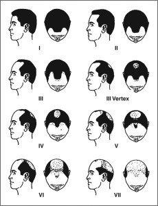 male-pattern-baldness-or-androgenetic-alopecia-230x300